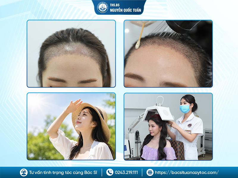 Làm thế nào để hạn chế sẹo sau khi cấy tóc?