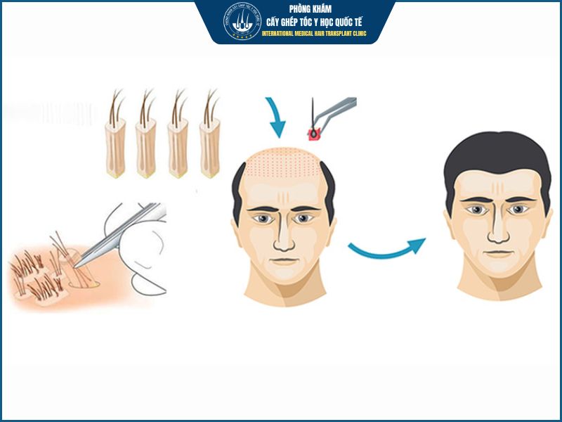 Hiểu đúng hơn về cấy tóc tự thân