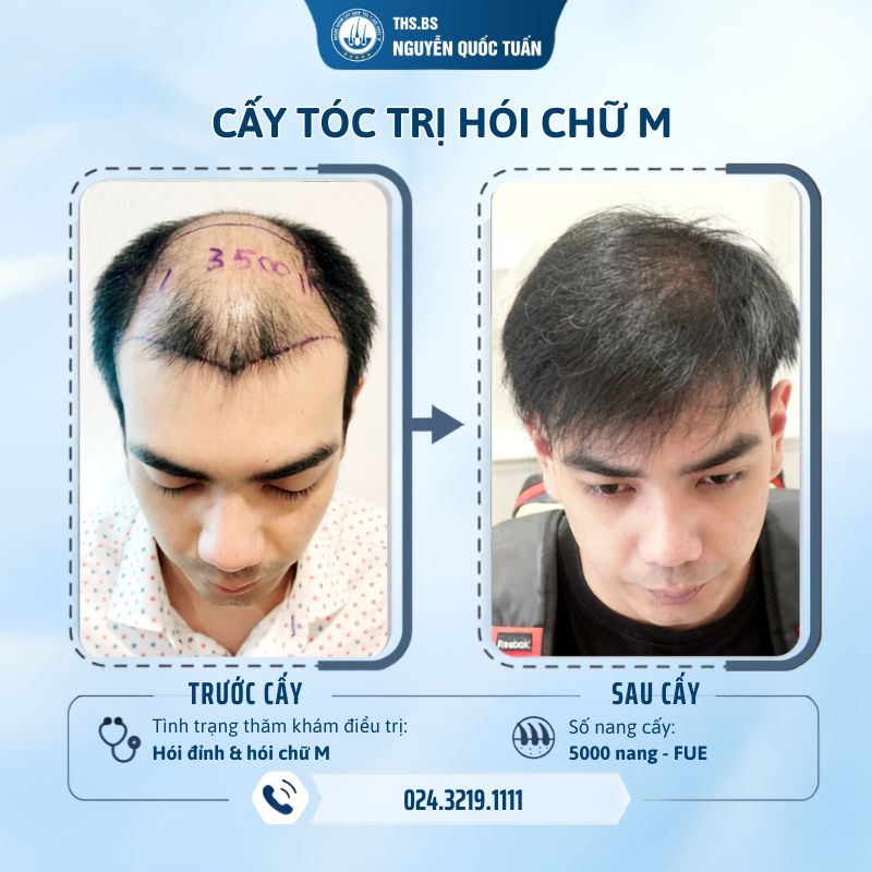 Kết quả cấy tóc kĩ thuật FUE