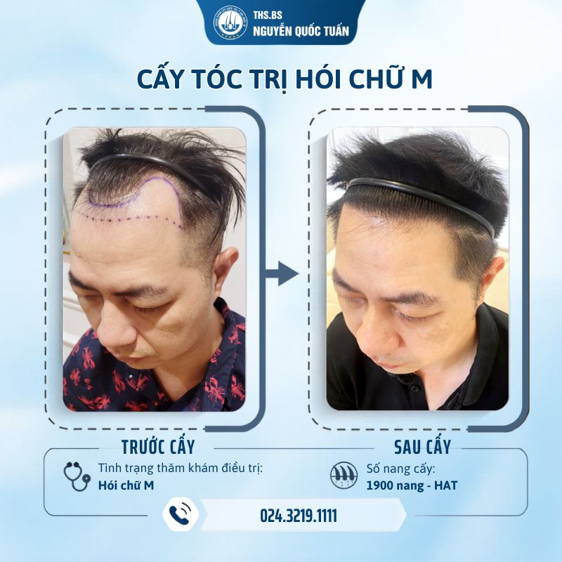 Cấy tóc hiệu quả với hói di truyền như thế nào? 
