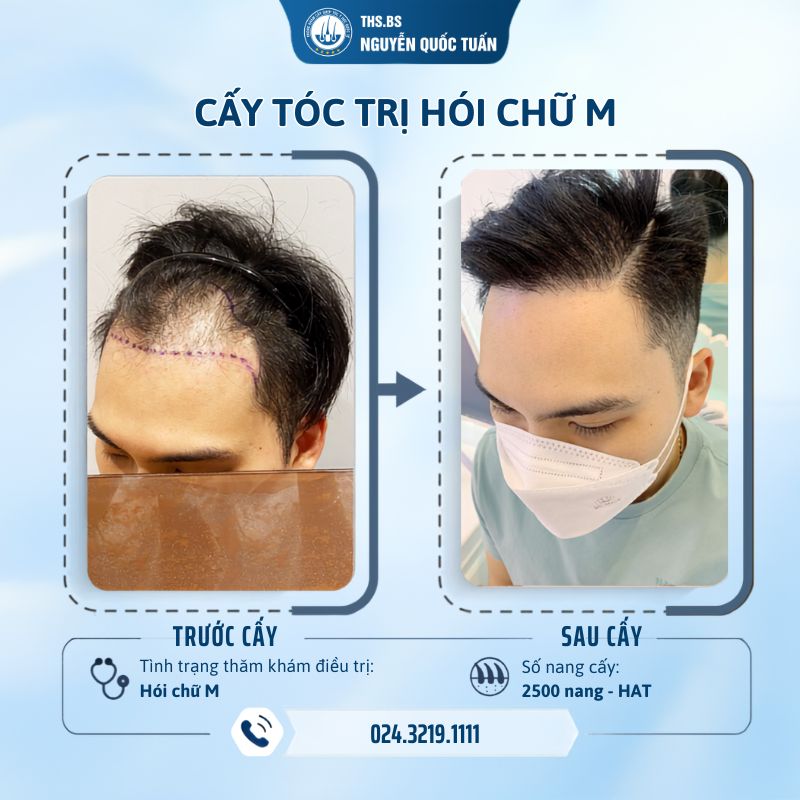 Hiệu quả quá trình chữa hói chữ M bằng phương pháp cấy tóc tự thân  