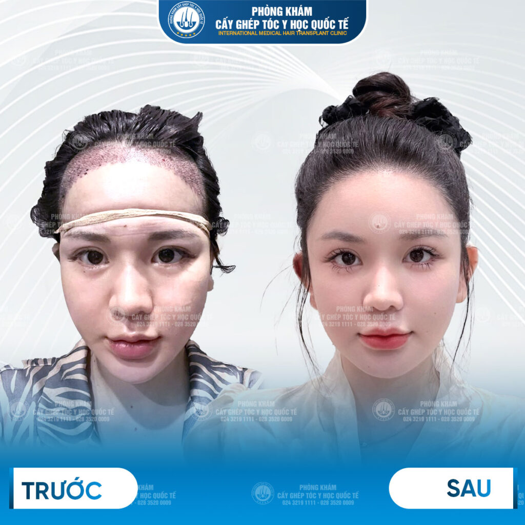Cấy đường chân tóc trán có mang lại vẻ đẹp tự nhiên không?