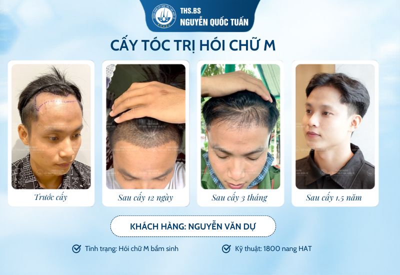Hiệu quả quá trình cấy tóc kĩ thuật HAT
