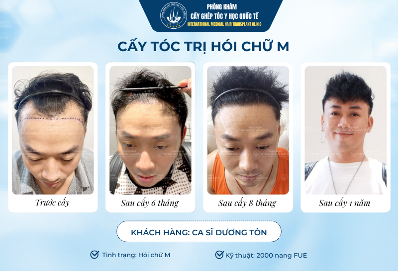 Cấy tóc bao lâu thì thấy tóc mọc lại? 