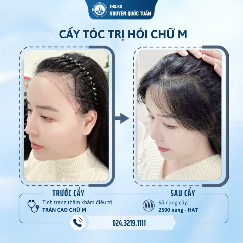 Cấy tóc tự thân – giải pháp phục hồi mật độ lâu dài 