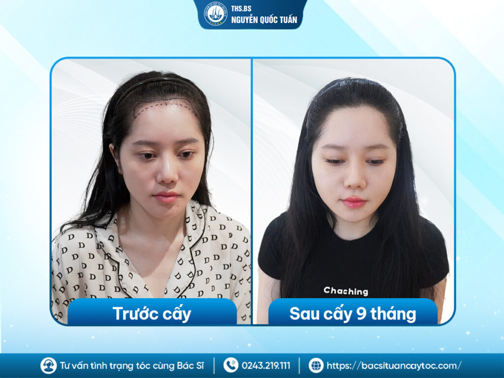 Cấy tóc tự thân có an toàn không trong thực tế 