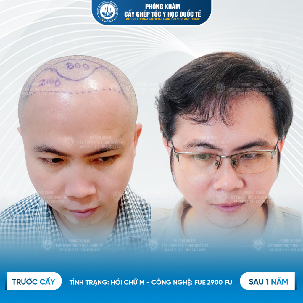 Hiệu quả của quá trình cấy tóc tự thân sau 1 năm 