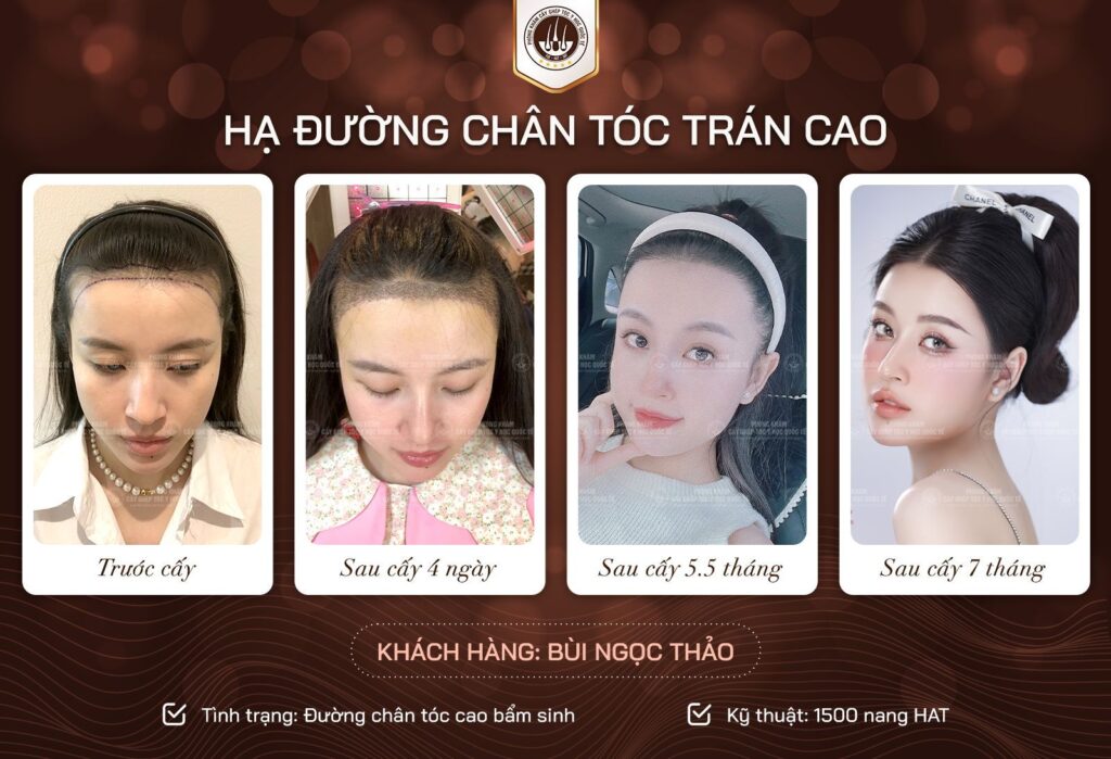 Nắm rõ thời gian phục hồi giúp theo dõi kết quả chính xác hơn