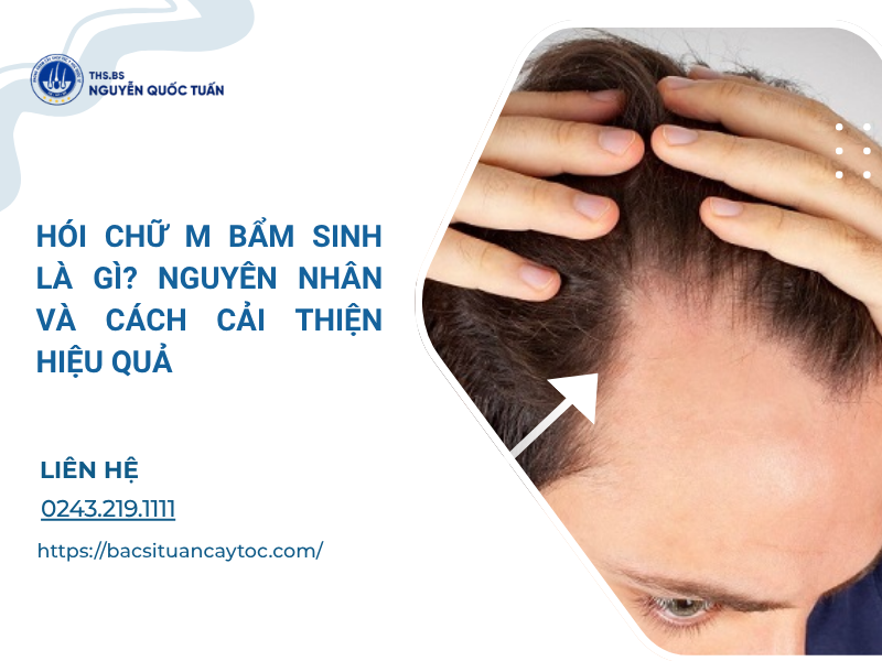 hói chữ m bẩm sinh