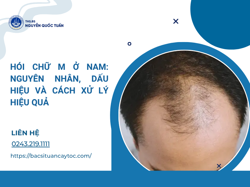 hói chữ m ở nam