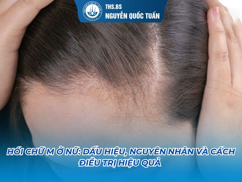 hói chữ m ở nữ