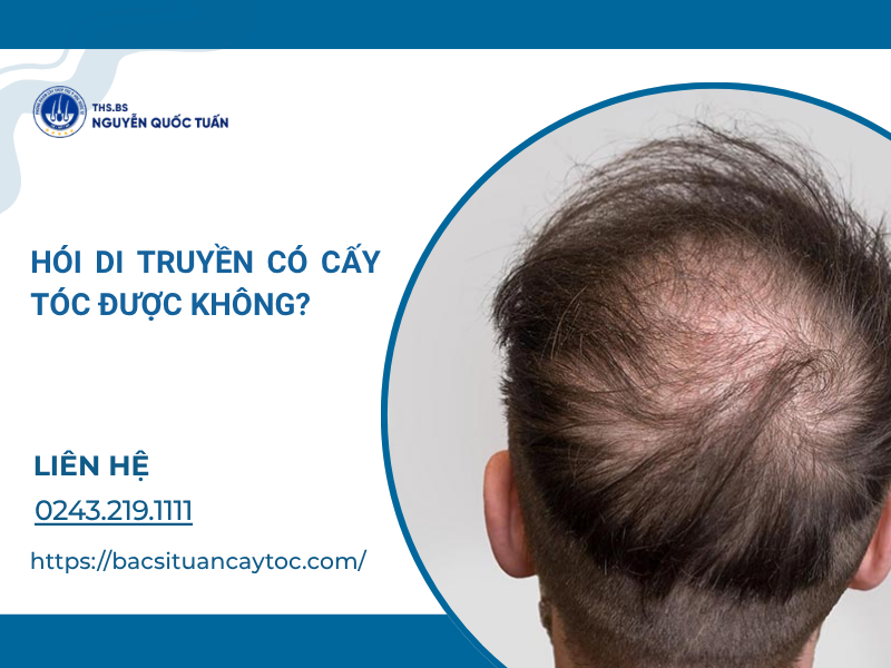 hói di truyền có chữa được không
