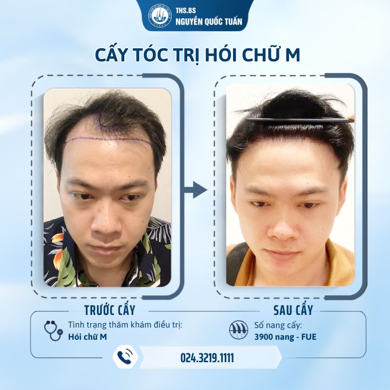 Kết quả một ca cấy tóc tự thân