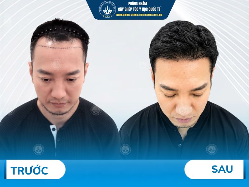 điều gì mới tạo nên kết quả sau cấy 