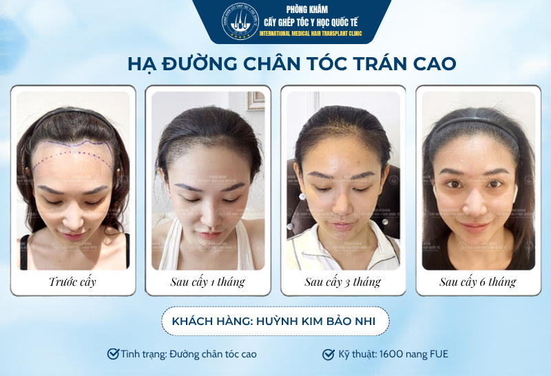 Kết quả cấy hạ đường chân tóc sau 6 tháng