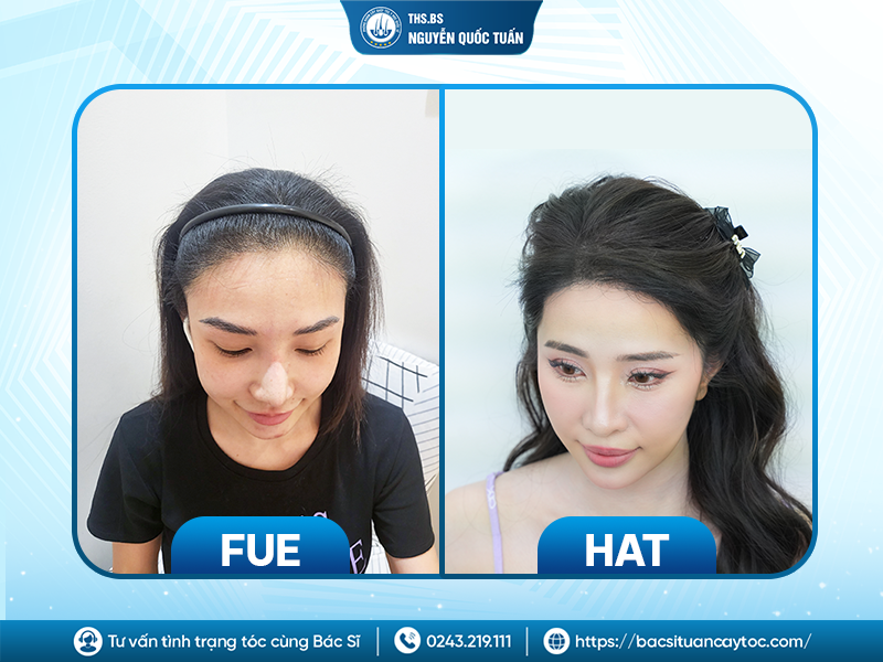 Vì sao cùng cấy tóc nhưng kết quả FUE và HAT có thể khác nhau? 