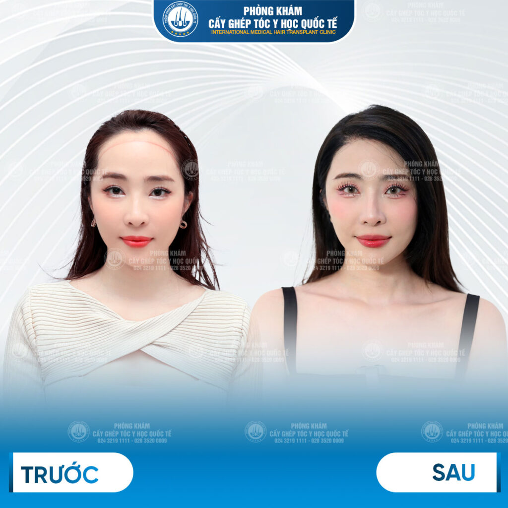 cấy tóc bao lâu mọc lại và khi nào thấy kết quả rõ ràng?