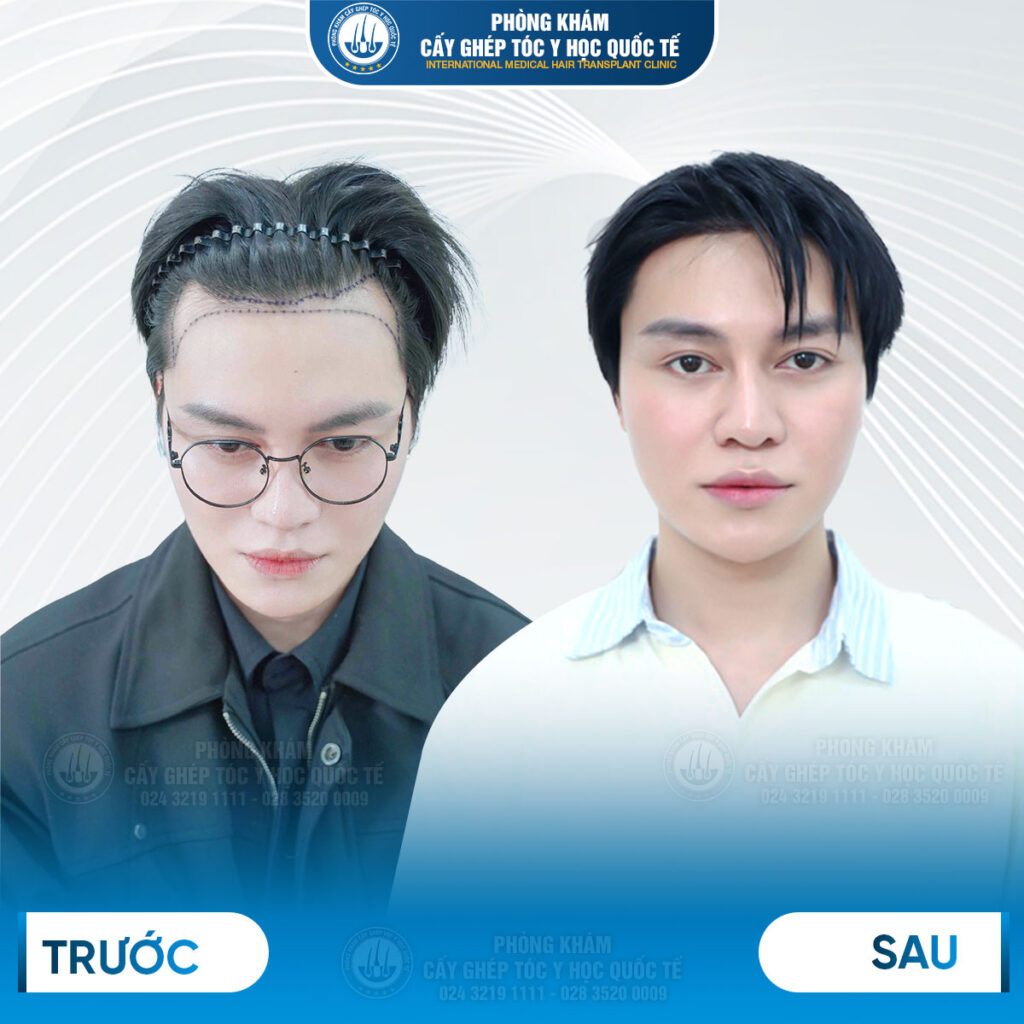 Mức độ đau phụ thuộc vào yếu tố nào: Công nghệ hay tay nghề?