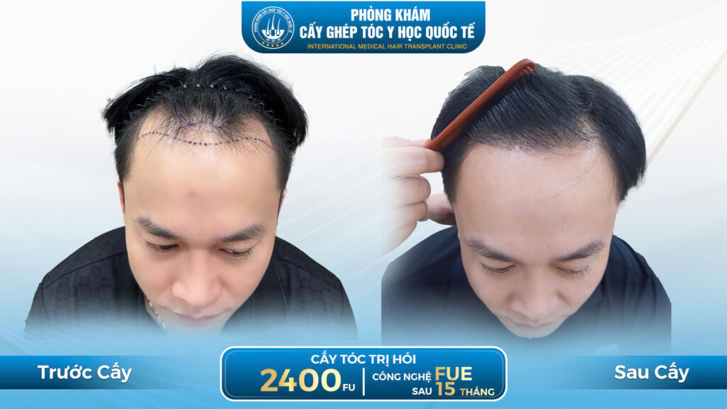 Kết quả sau 15 tháng cấy tóc của khách hàng