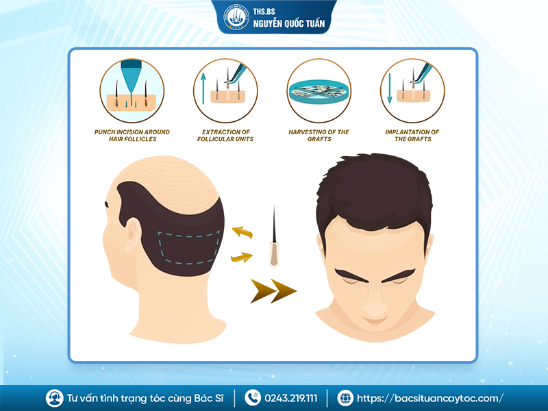 Cấy tóc FUE và HAT khác nhau ở điểm nào? 