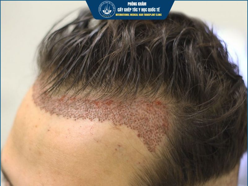 Cấy tóc có rủi ro không? 