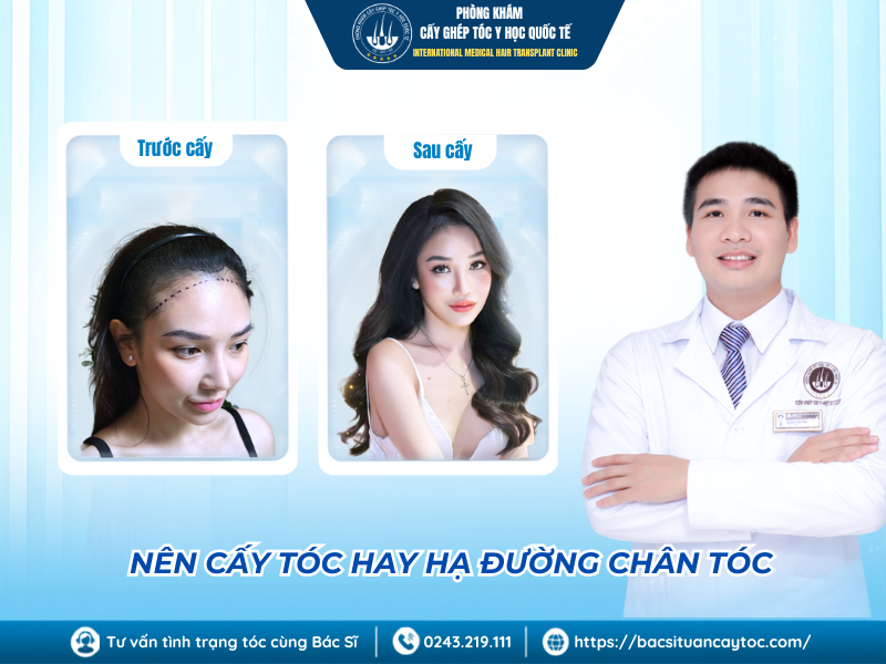 nên cấy tóc hay hạ đường chân tóc