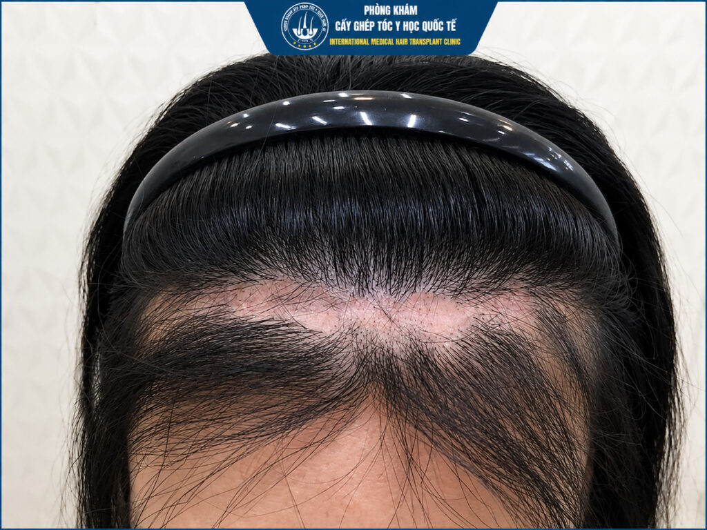 Hạ đường chân tóc phù hợp trong trường hợp nào?