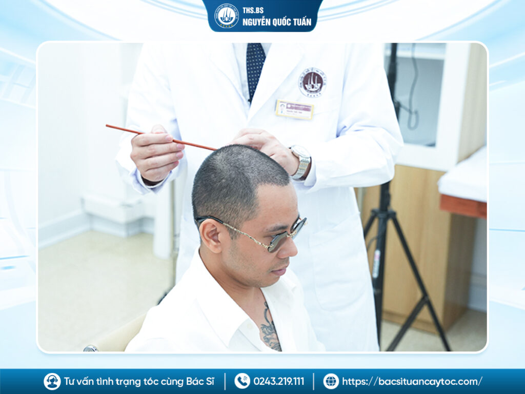 Phẫu thuật cấy tóc điều trị hói là gì?