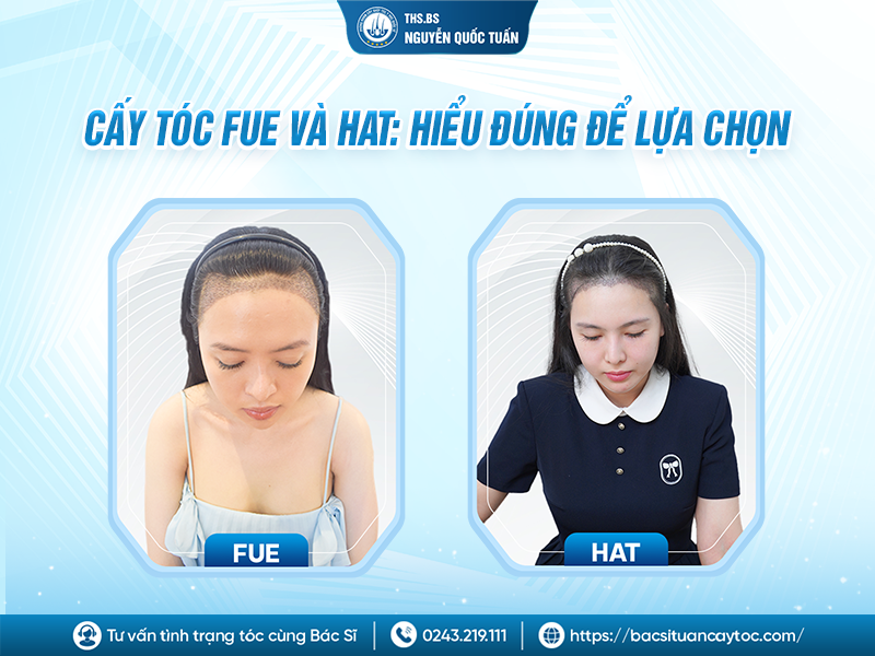 phương pháp cấy tóc có hiệu quả không