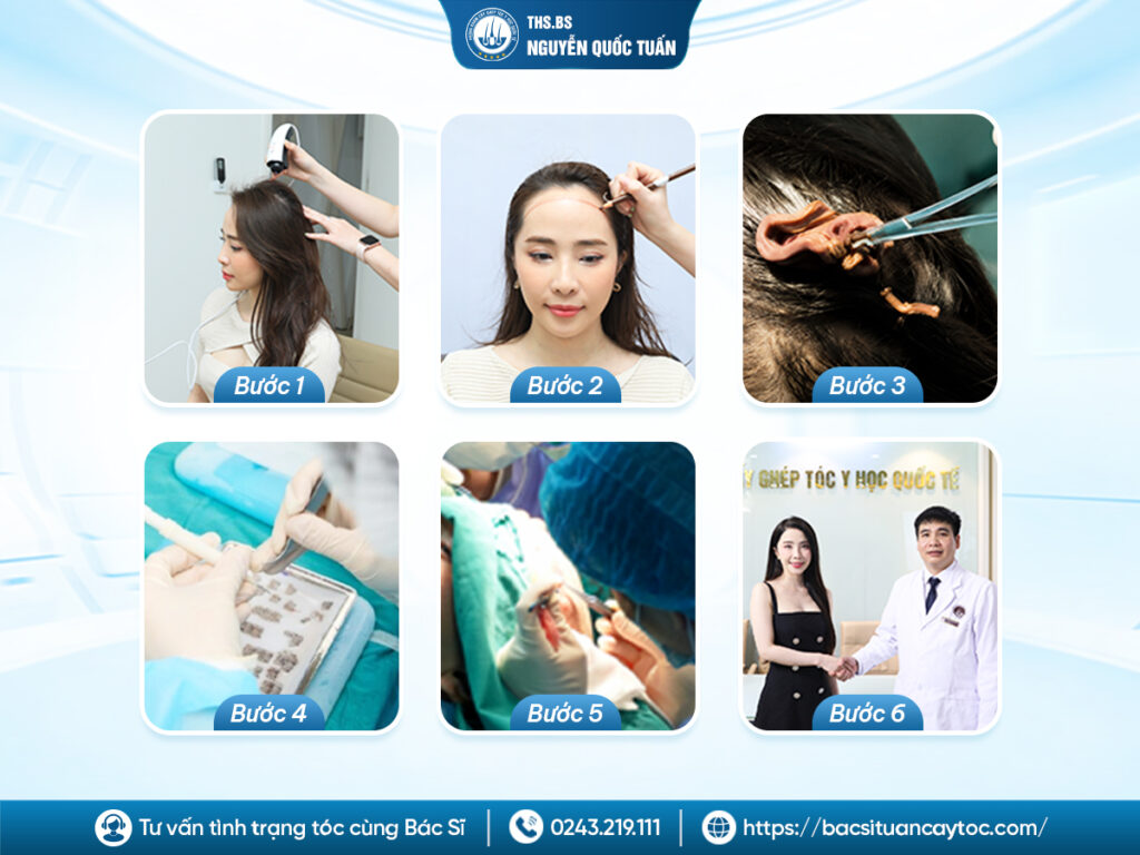 Quá trình cấy tóc diễn ra như thế nào? Có đau và rủi ro không?