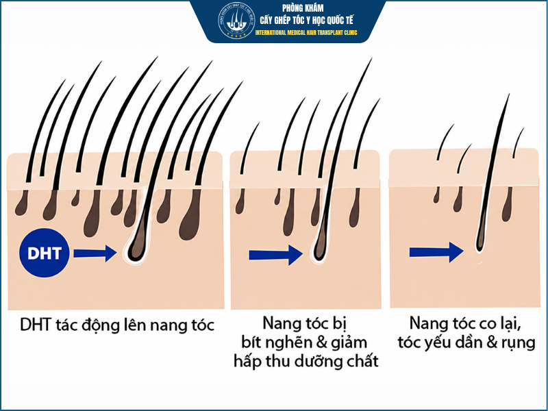 Quá trình rụng tóc nội tiết đang tiến triển. 