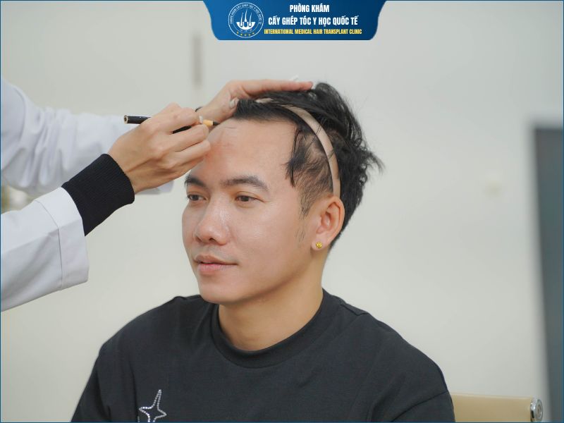 Cấy tóc vùng chữ M được thực hiện như thế nào?