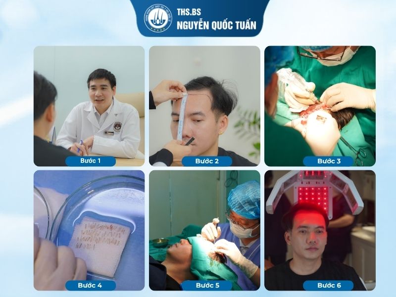 Quy trình cấy tóc gọn trong 6 bước chính 
