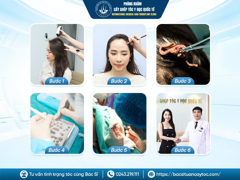 Quy trình thực hiện cấy đường chân tóc diễn ra như thế nào