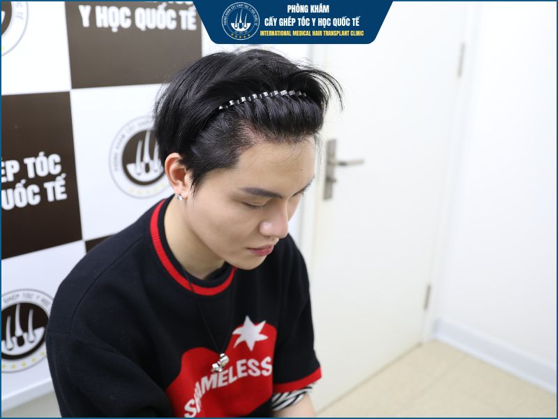 Sau cấy tóc bao lâu mới được gội đầu? 