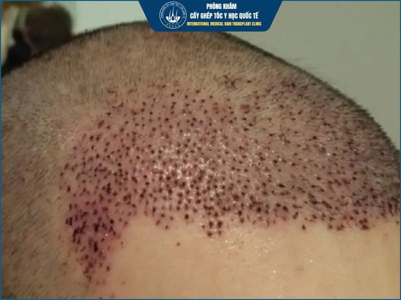 sưng nề da đầu sau cấy tóc