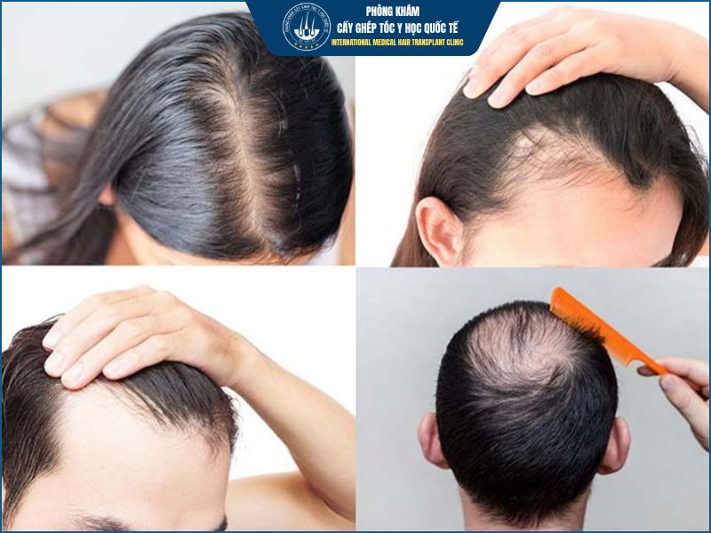  Những trường hợp nên thực hiện cấy tóc tự thân
