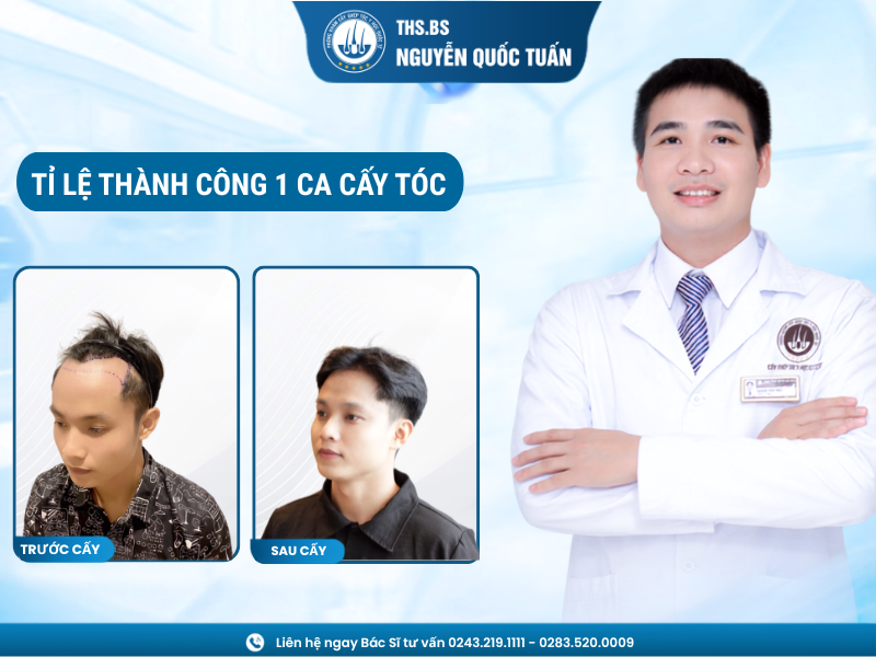 tỉ lệ thành công 1 ca cấy tóc