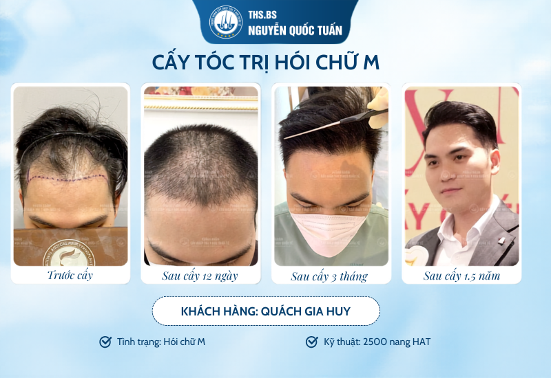 Tỉ lệ thành công của ca cấy tóc có thật sự đạt tới 98%