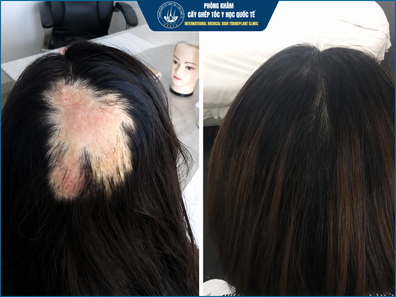 Điều kiện quan trọng để cấy tóc trên sẹo có tỷ lệ thành công cao