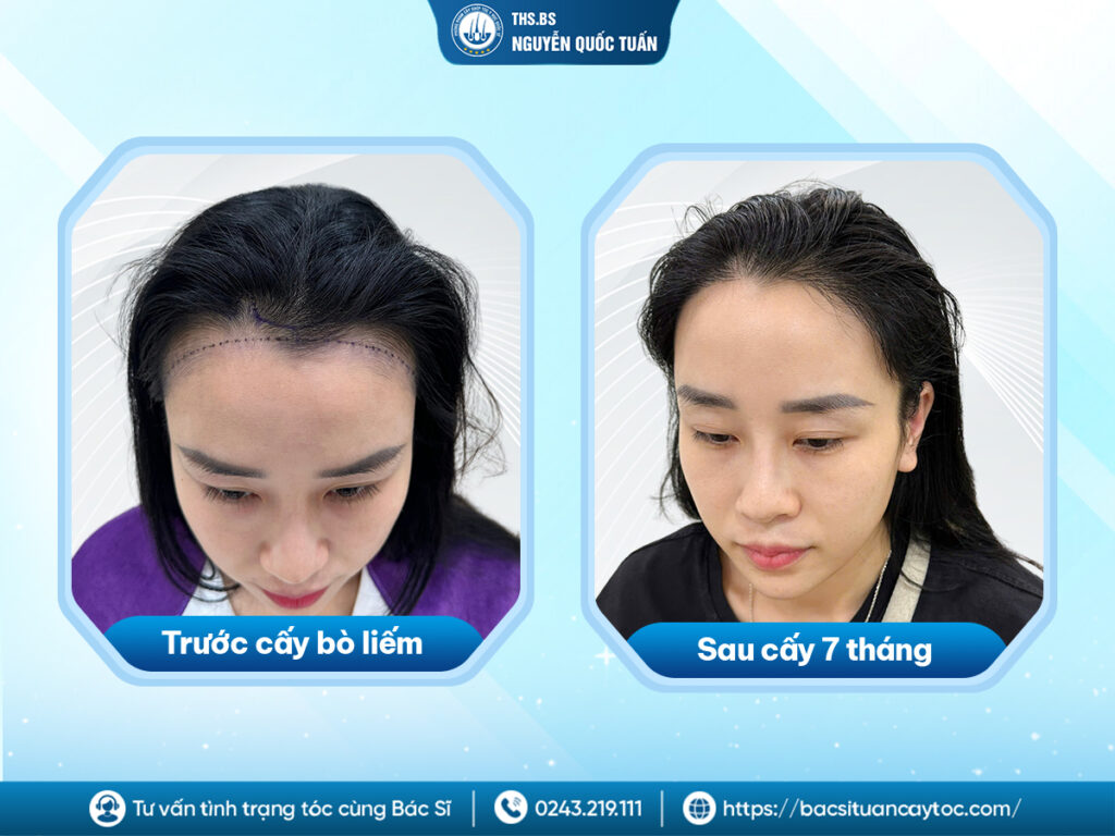Vì sao cấy tóc trị bò liếm mang lại hiệu quả?