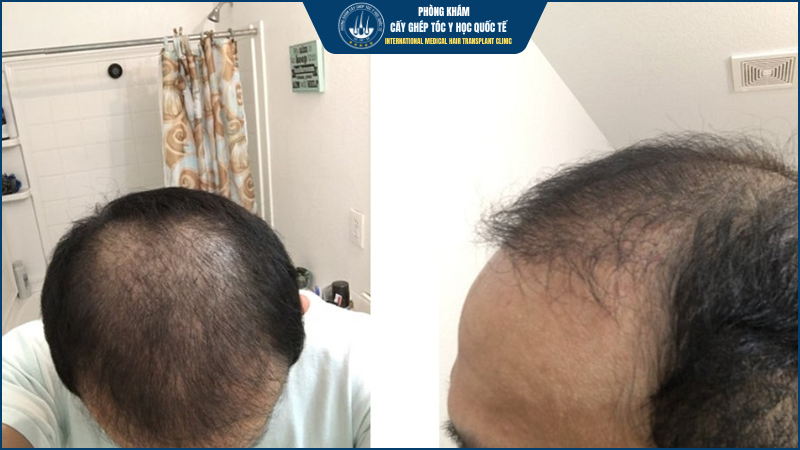 Tóc mọc không đồng đều – Hiện tượng tạm thời không đồng nghĩa với cấy tóc thất bại 