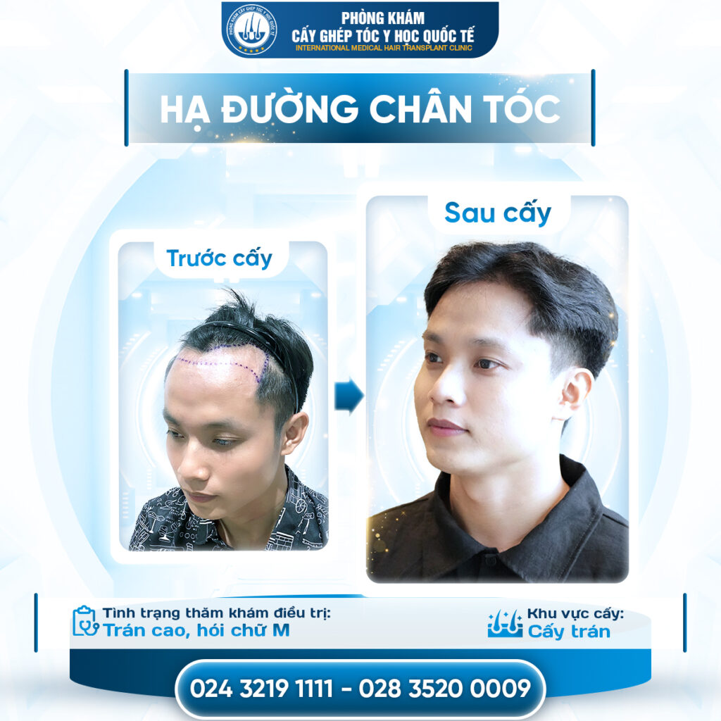 Kết quả thực tế và tiến trình mọc tóc