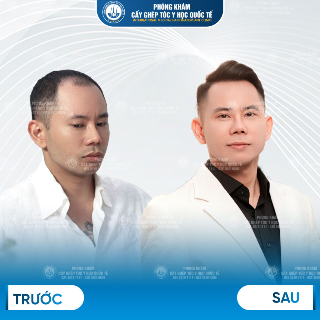  Làm thế nào để cấy tóc tự thân an toàn và đạt hiệu quả cao? 
