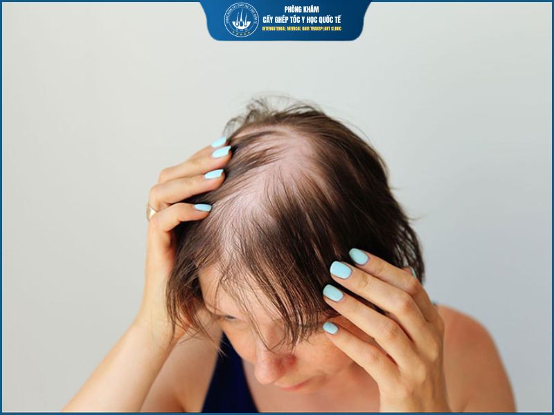 Khi nào KHÔNG nên chọn cấy tóc PNS