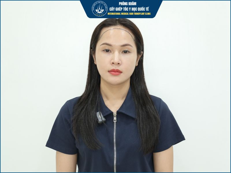 Ai nên cấy hạ đường chân tóc?