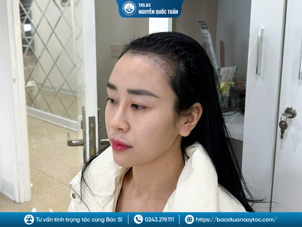 Trường hợp nào nên cấy tóc trán bò liếm?