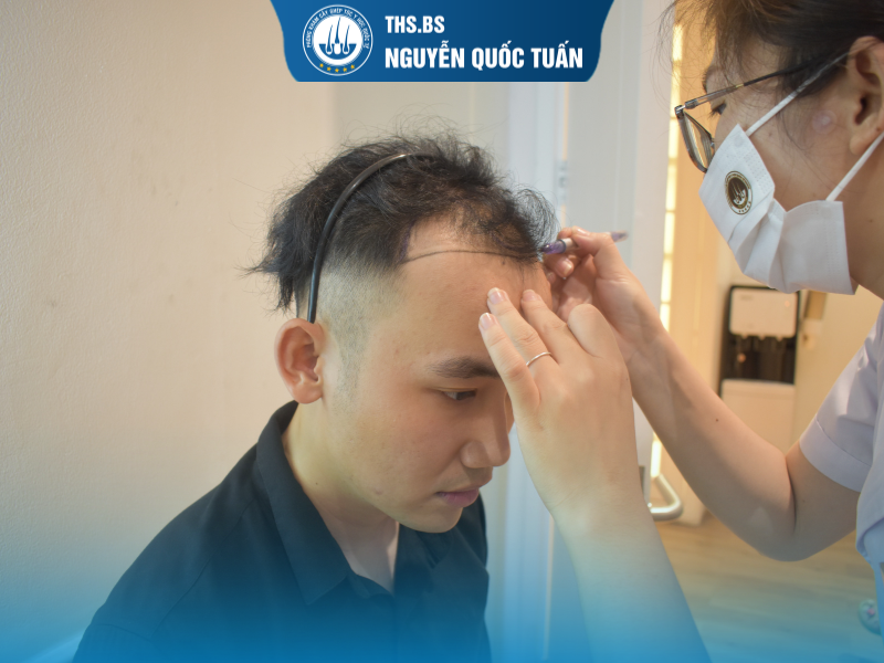 Trường hợp nào nên cấy FUE hay DHI