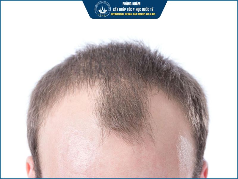 Ai phù hợp và không phù hợp cấy tóc? 