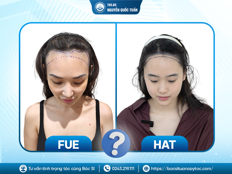 Trường hợp nào nên chọn FUE, khi nào nên chọn HAT? 